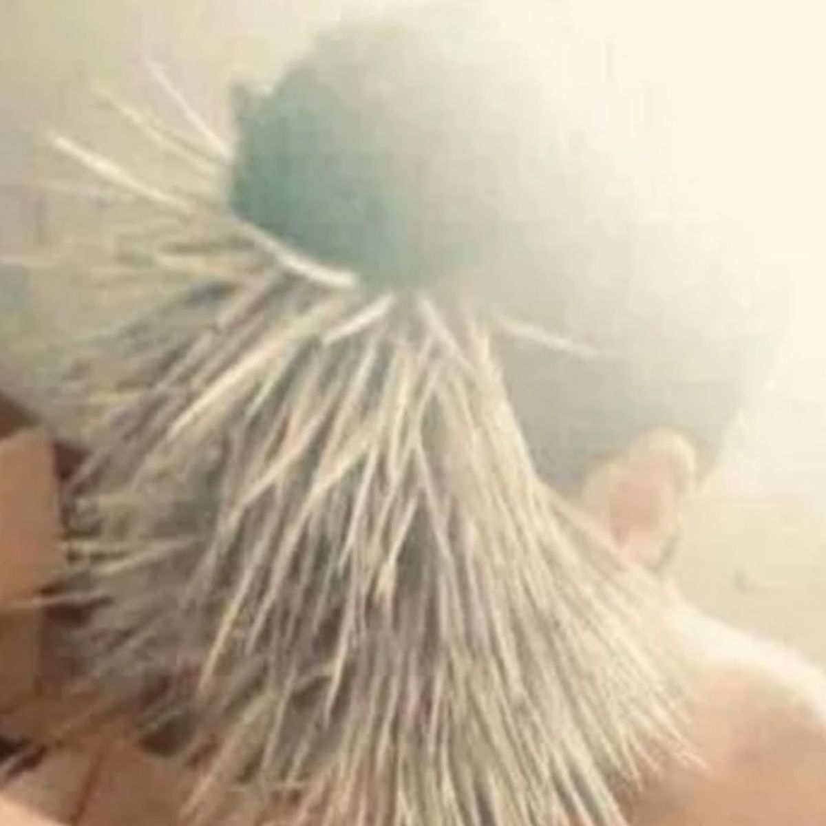 human porcupine attack