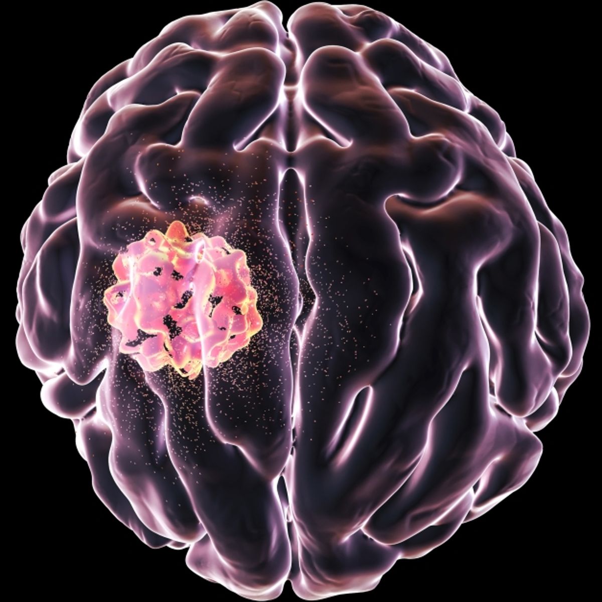 Did University Students Develop Compound That Kills Brain Cancer Cells? |  