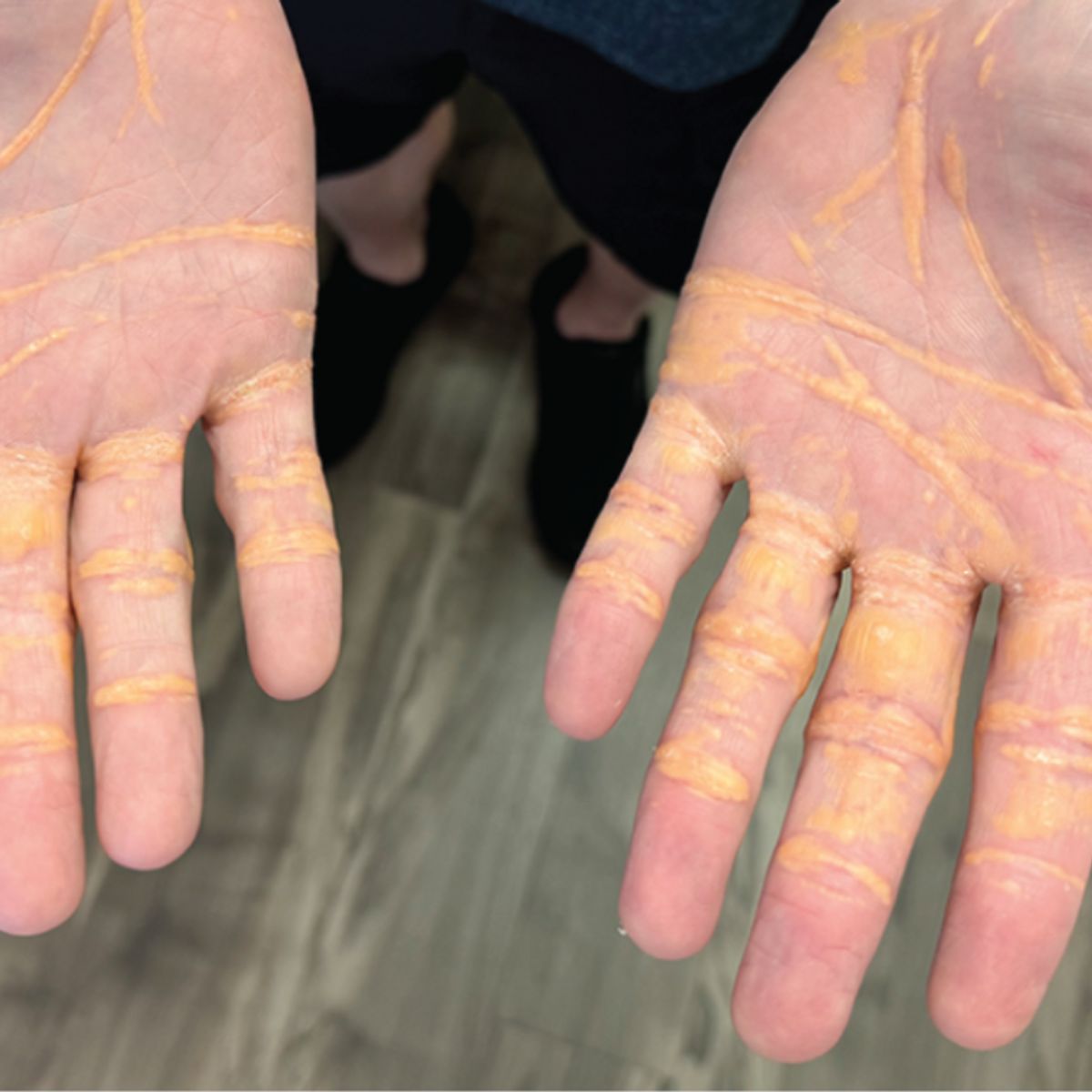 cholesterol_yellow_nodules_on_hands_carnivore_diet.png