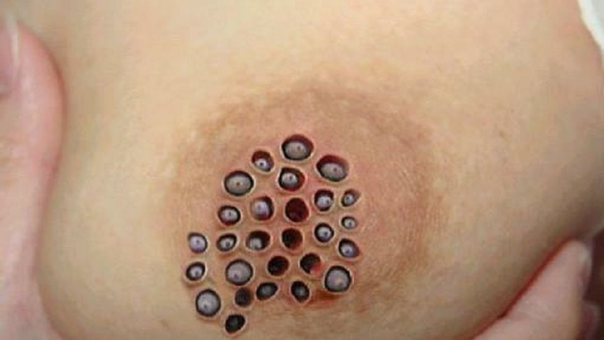 Any large chested ladies get a rash under breast?? (Sorry - pic included)