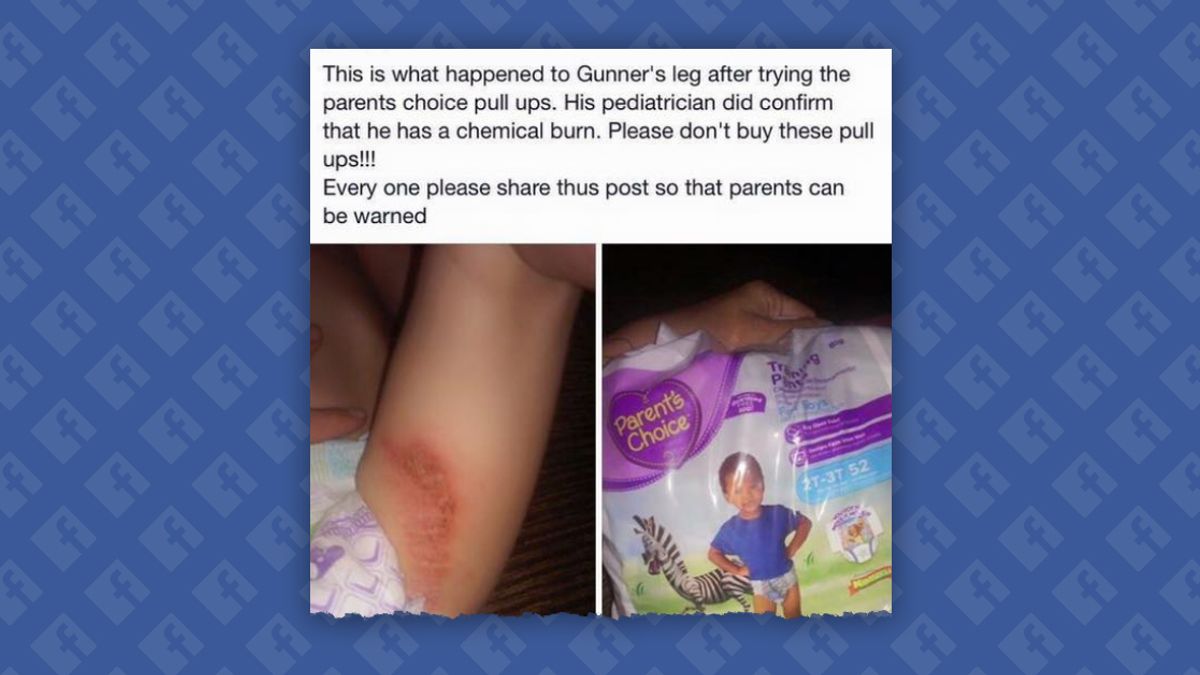 Are Parent's Choice Diapers Giving Babies Chemical Burns?
