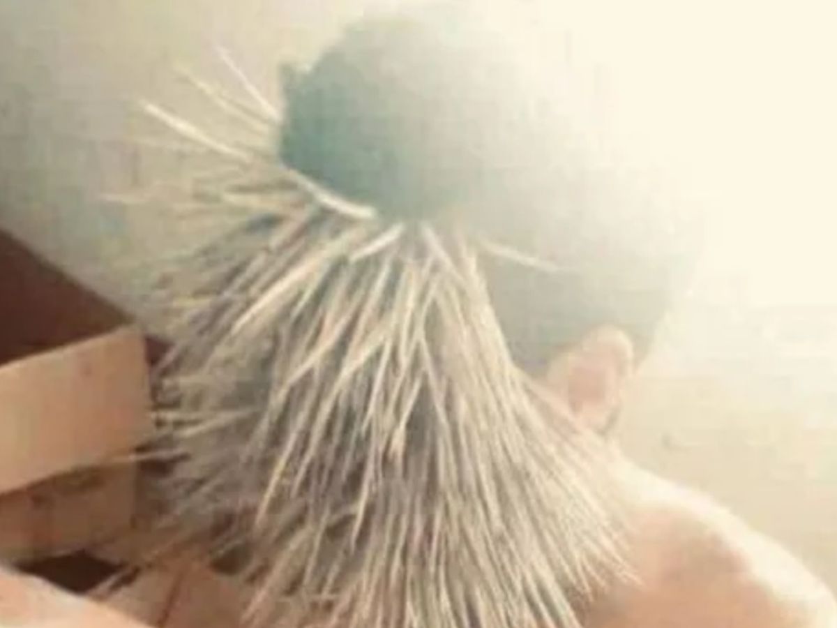 porcupine attack human