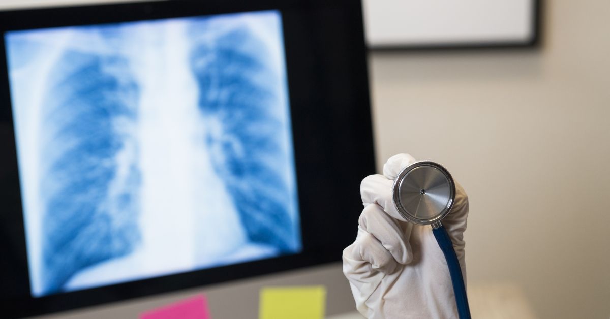 The doctor is analyzing the patient's lung X-rays, the flu concept or the Covid-19 virus (Getty Images/Stock photo)