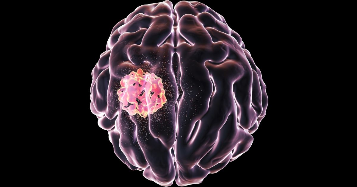 Conceptual image for brain cancer treatment. Computer illustration showing destruction of brain tumour. (Getty Images)