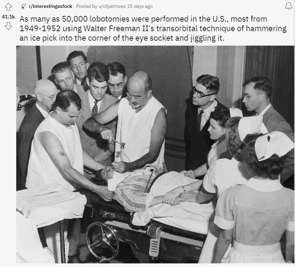 50,000 ice pick lobotomies were performed in the 1950s