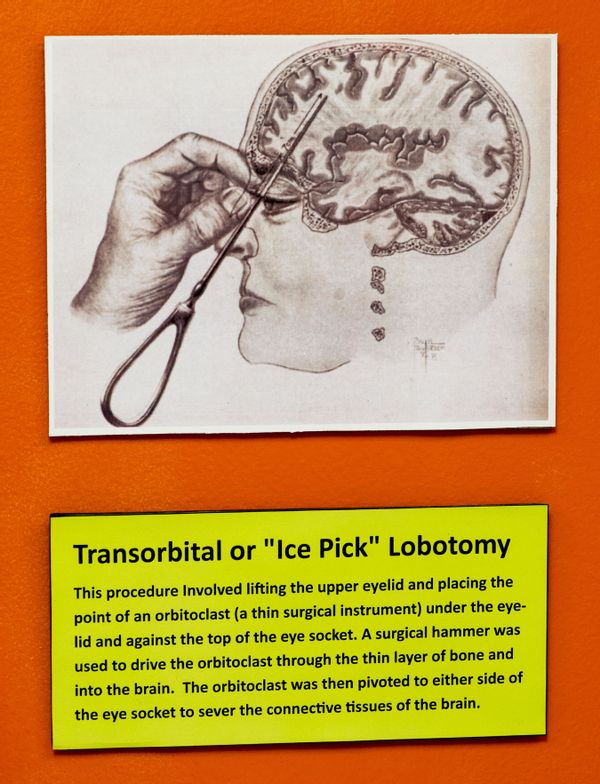 ice pick lobotomy diagram - Were Lobotomies Performed with Ice Picks in the 1950s?