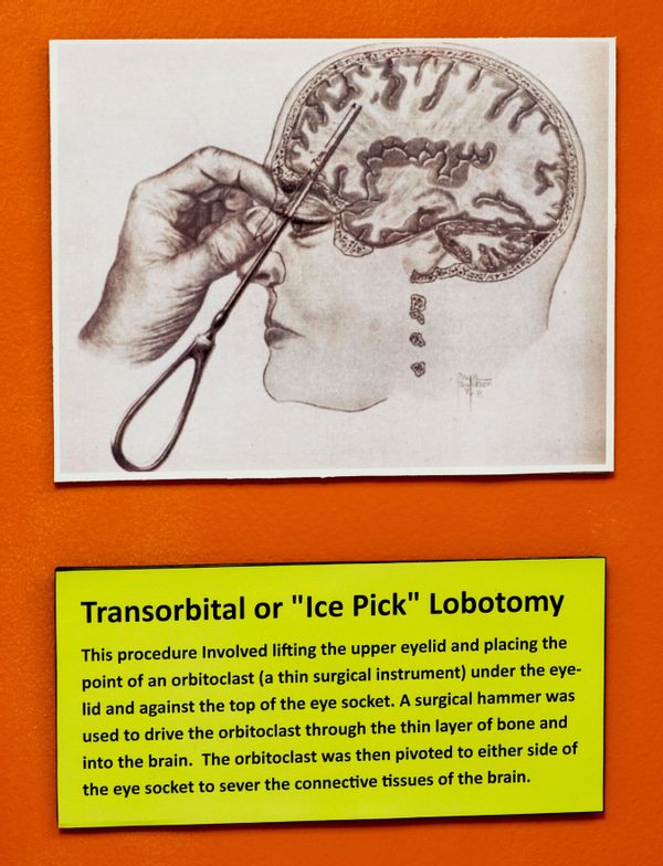 lobotomy before and after brain