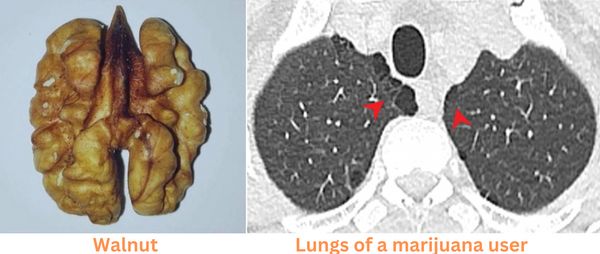 pot smokers lungs vs healthy lungs