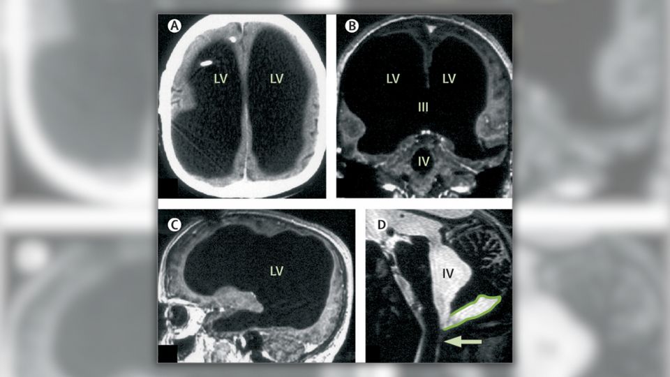 Medical Images Show Man with 90% of His Brain 'Missing'? | Snopes.com